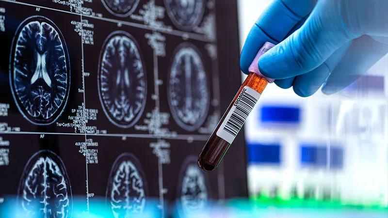 Essays New Goals - New Hope for Alzheimer's Disease