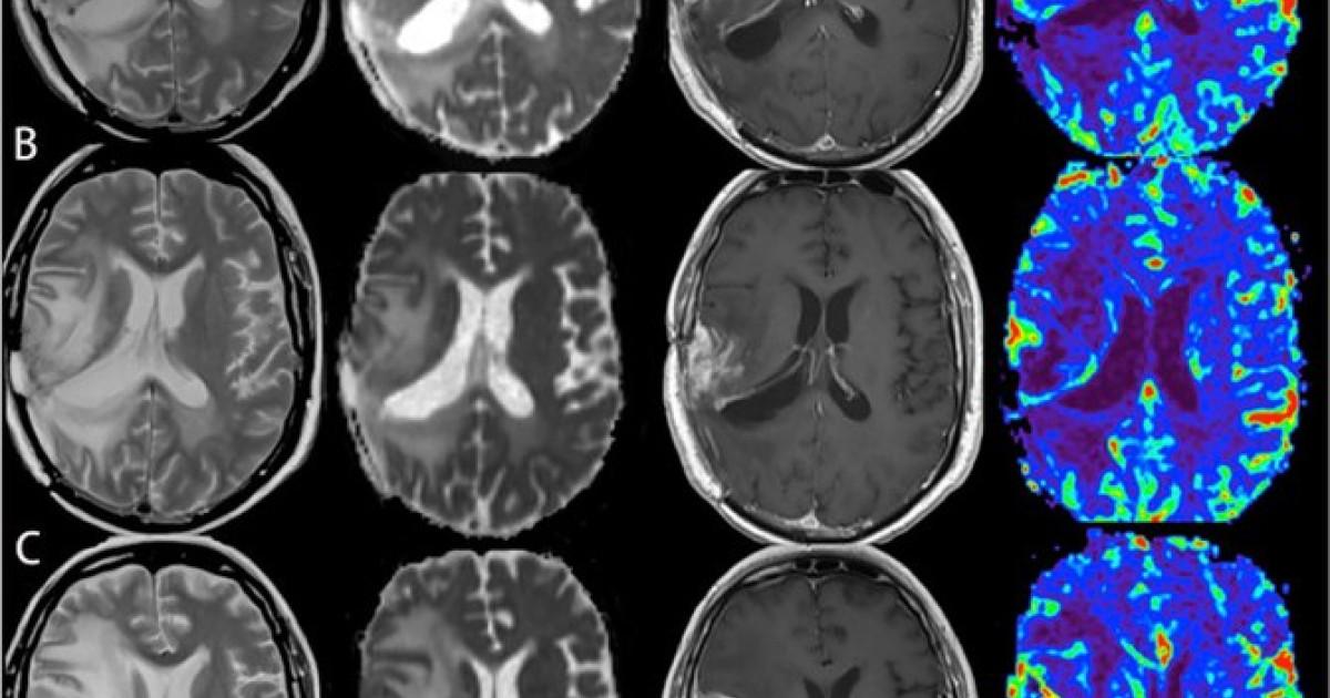 Indican que un molecular puede detener uno de los peores cuerpos del cerebro